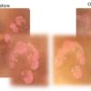 Psoriasis before and after Psorio kit Psoriasis before and after Psorio kit