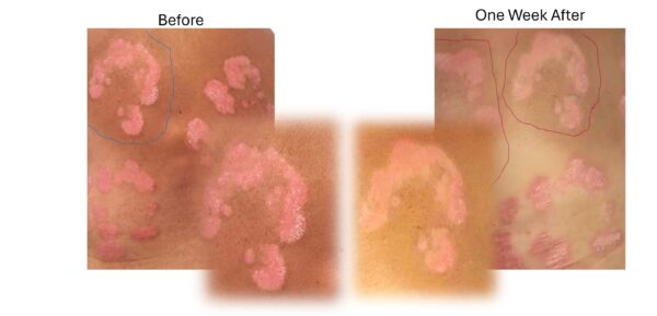 Psoriasis before and after Psorio kit Psoriasis before and after Psorio kit