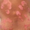 Psoriasis
