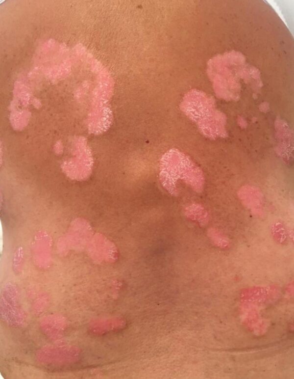Psoriasis