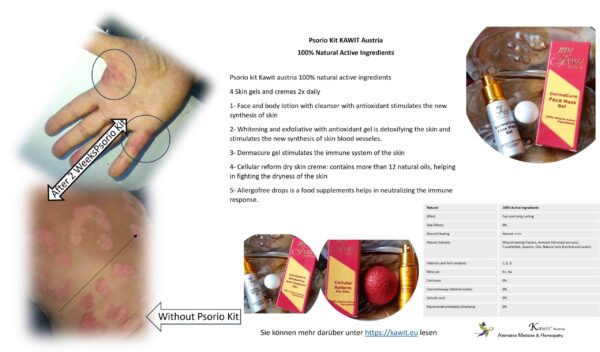 Psoriasis Natural Kit Psoriasis Natural Kit